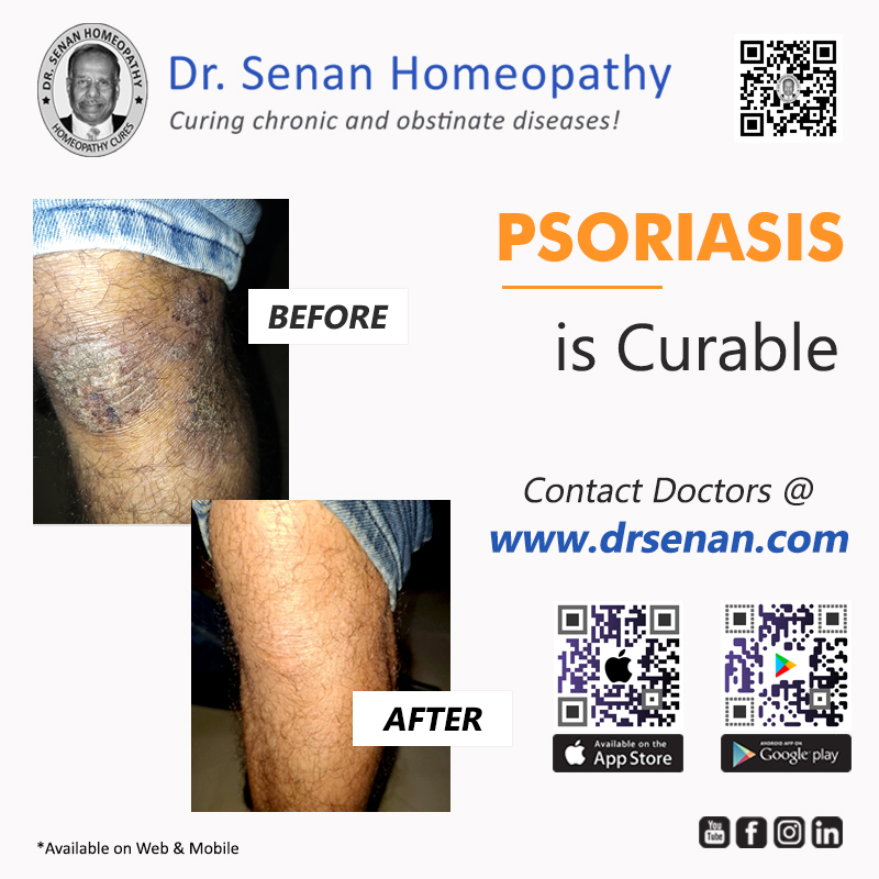 Psoriasis