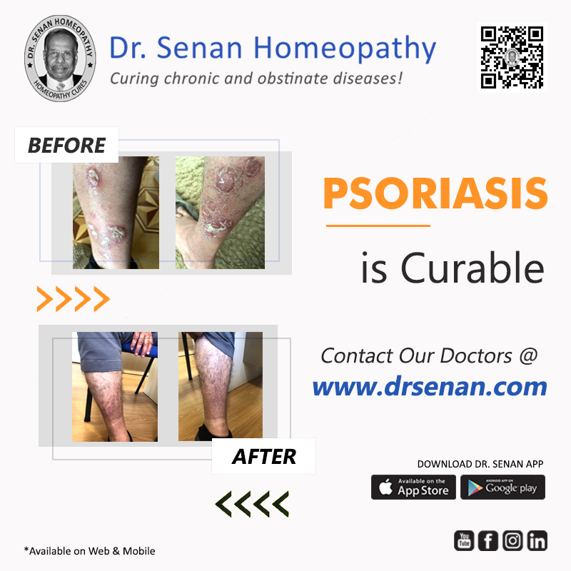 Psoriasis
