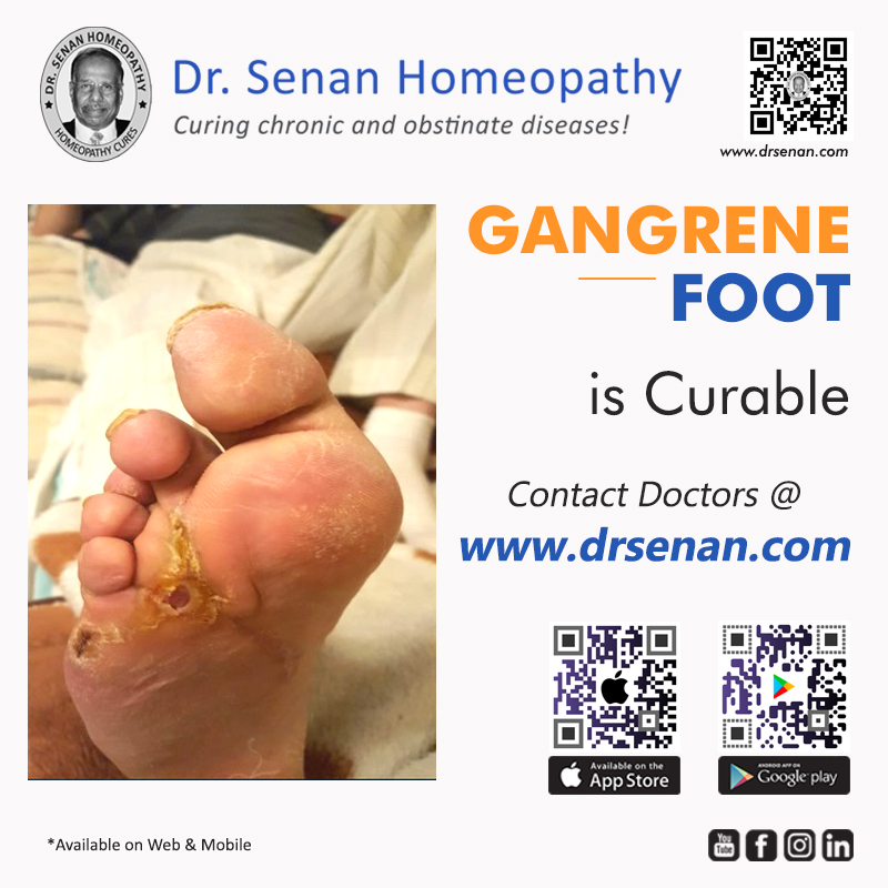 Gangrene