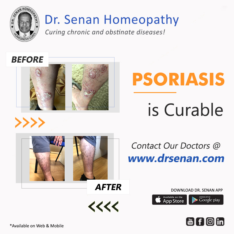Psoriasis